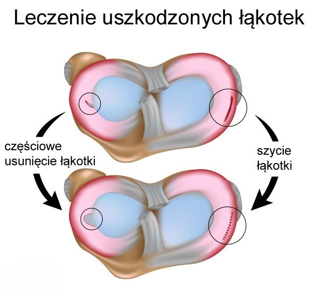 łąkotka2